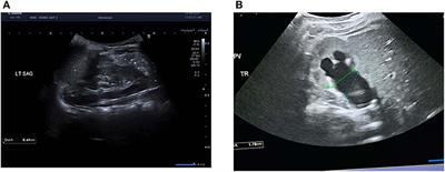 Ultrasound-Based Scoring System for Indication of Pyeloplasty in Patients With UPJO-Like Hydronephrosis